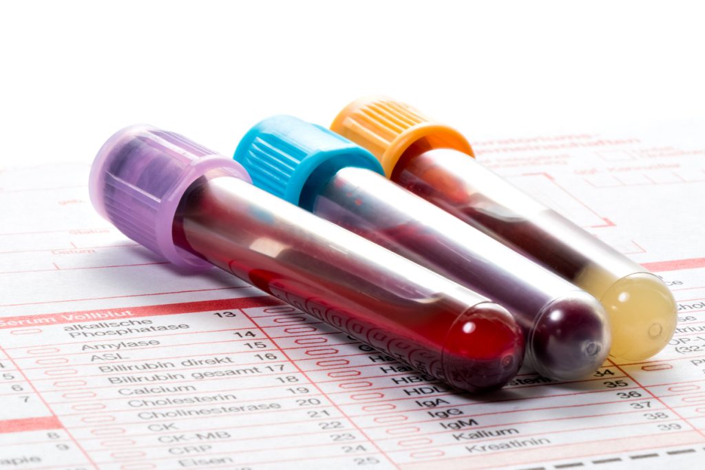 Blood test, blood samples on a laboratory form-1024x683