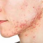 acne acne