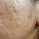 acne scaring acne scaring