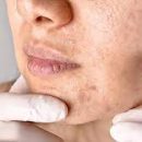 clogged skin pores clogged skin pores