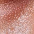 oily skin oily skin