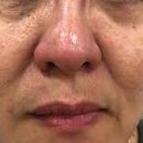 uneven skin uneven skin