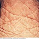 wrinkles wrinkles